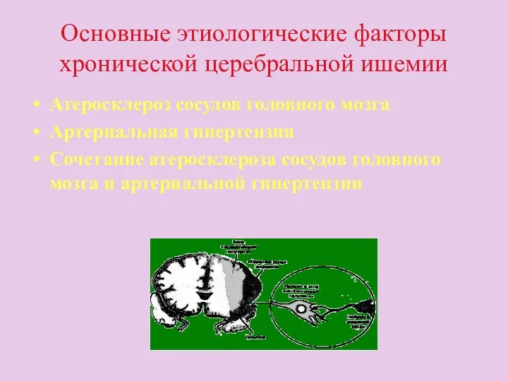 Основные этиологические факторы хронической церебральной ишемии Атеросклероз сосудов головного мозга