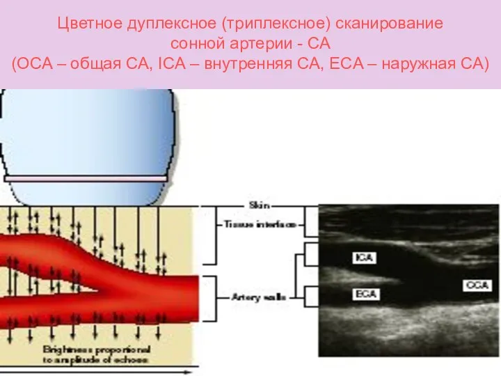 Цветное дуплексное (триплексное) сканирование сонной артерии - СА (OCA –