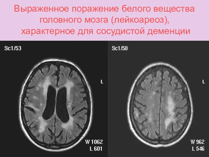 Выраженное поражение белого вещества головного мозга (лейкоареоз), характерное для сосудистой деменции