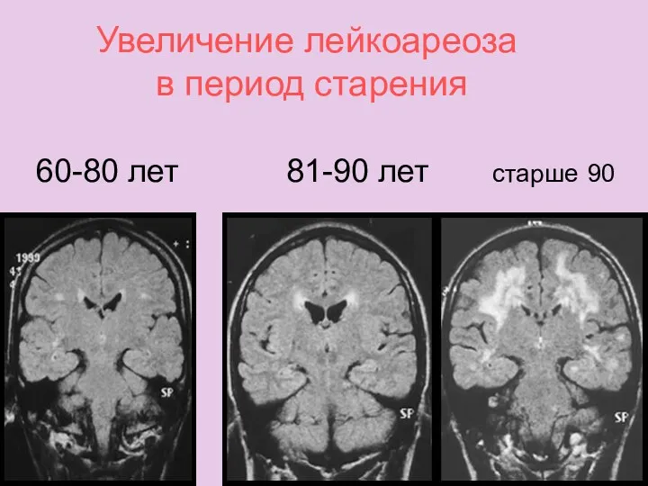 Увеличение лейкоареоза в период старения 60-80 лет 81-90 лет старше 90