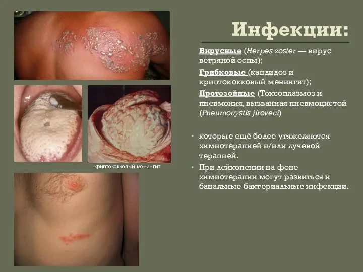 Инфекции: Вирусные (Herpes zoster — вирус ветряной оспы); Грибковые (кандидоз и криптококковый менингит);