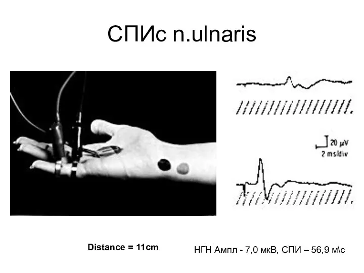 СПИc n.ulnaris Distance = 11cm НГН Ампл - 7,0 мкВ, СПИ – 56,9 м\с