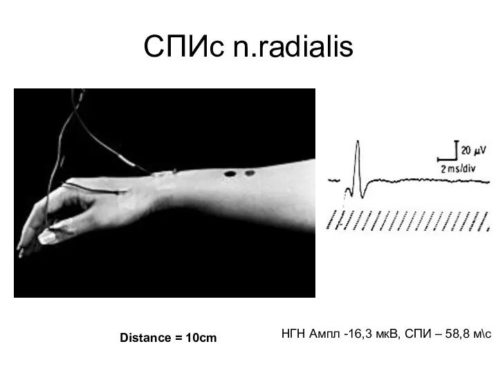 СПИc n.radialis Distance = 10cm НГН Ампл -16,3 мкВ, СПИ – 58,8 м\с