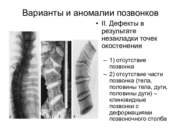 Варианты и аномалии позвонков II. Дефекты в результате незакладки точек