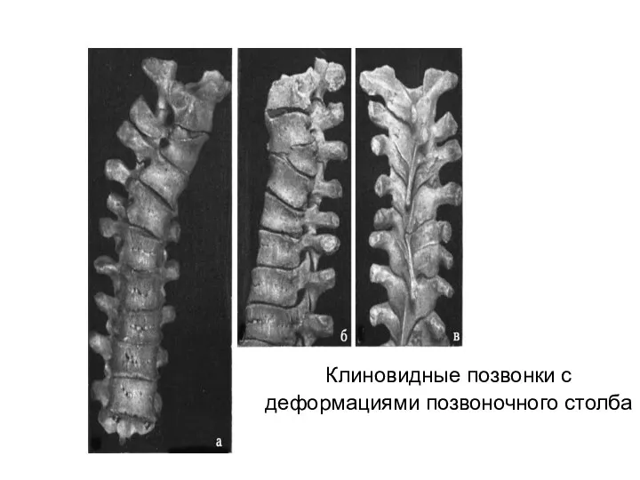 Клиновидные позвонки с деформациями позвоночного столба