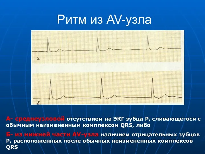 Ритм из AV-узла А- среднеузловой отсутствием на ЭКГ зубца Р,