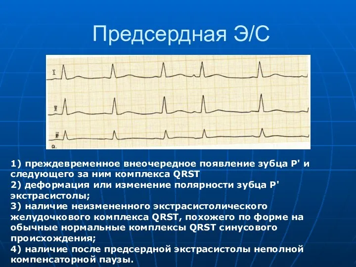 Предсердная Э/С 1) преждевременное внеочередное появление зубца Р' и следующего