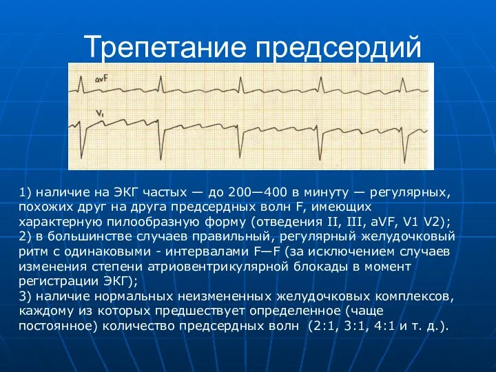 Трепетание предсердий 1) наличие на ЭКГ частых — до 200—400