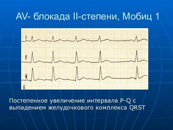 AV- блокада II-степени, Мобиц 1 Постепенное увеличение интервала P-Q c выпадением желудочкового комплекса QRST