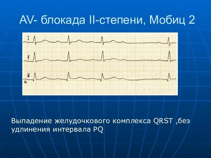 AV- блокада II-степени, Мобиц 2 Выпадение желудочкового комплекса QRST ,без удлинения интервала PQ