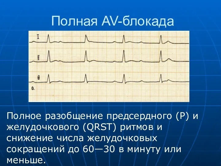 Полная AV-блокада Полное разобщение предсердного (Р) и желудочкового (QRST) ритмов