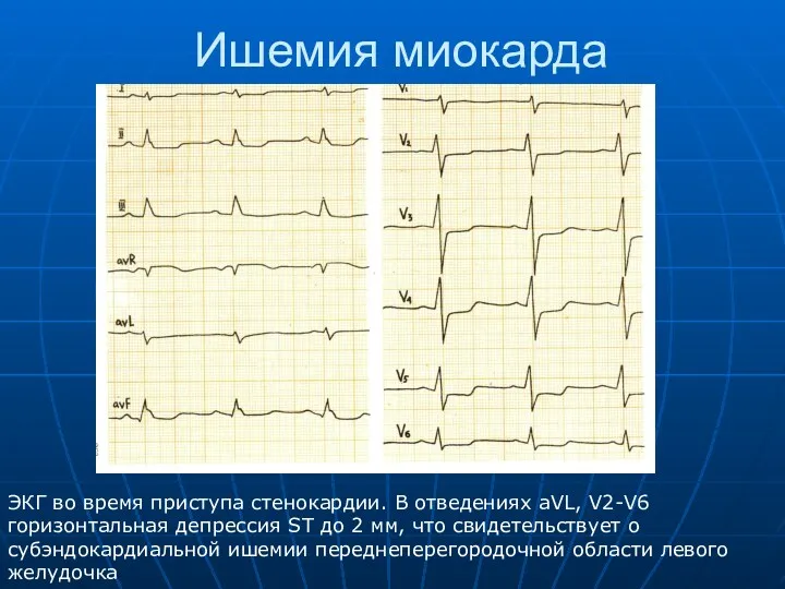 Ишемия миокарда ЭКГ во время приступа стенокардии. В отведениях aVL,