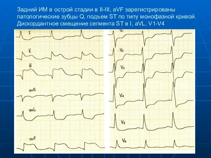 Задний ИМ в острой стадии в II-III, aVF зарегистрированы патологические