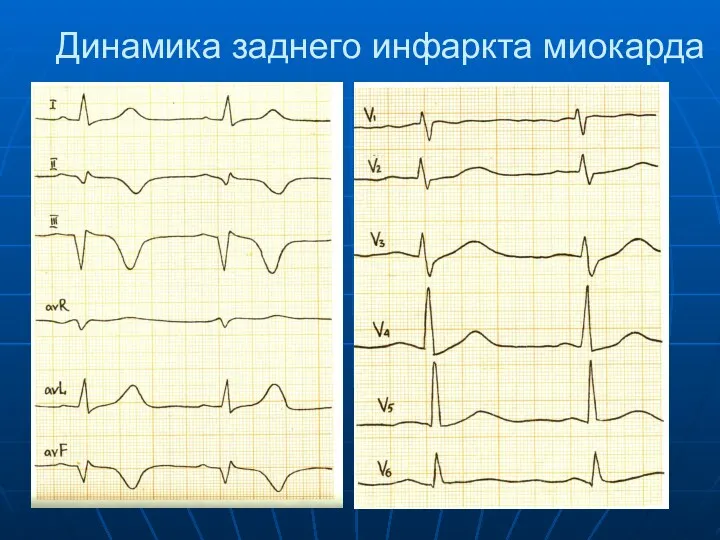 Динамика заднего инфаркта миокарда