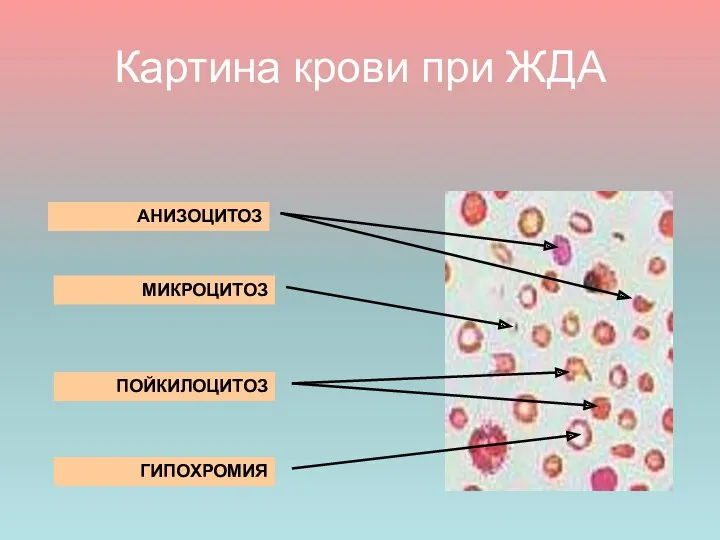 Картина крови при ЖДА АНИЗОЦИТОЗ МИКРОЦИТОЗ ПОЙКИЛОЦИТОЗ ГИПОХРОМИЯ