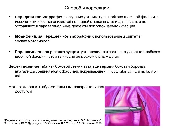 Способы коррекции Передняя кольпоррафия - создание дупликатуры лобково-шеечной фасции, с иссечением избытка слизистой