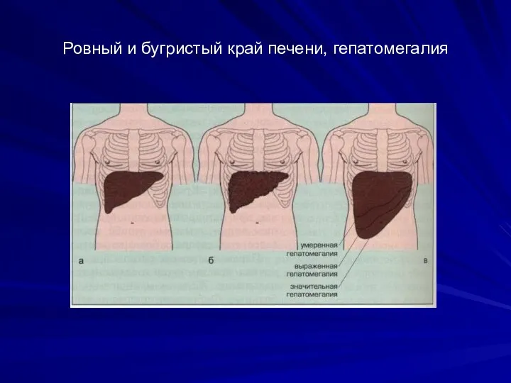 Ровный и бугристый край печени, гепатомегалия