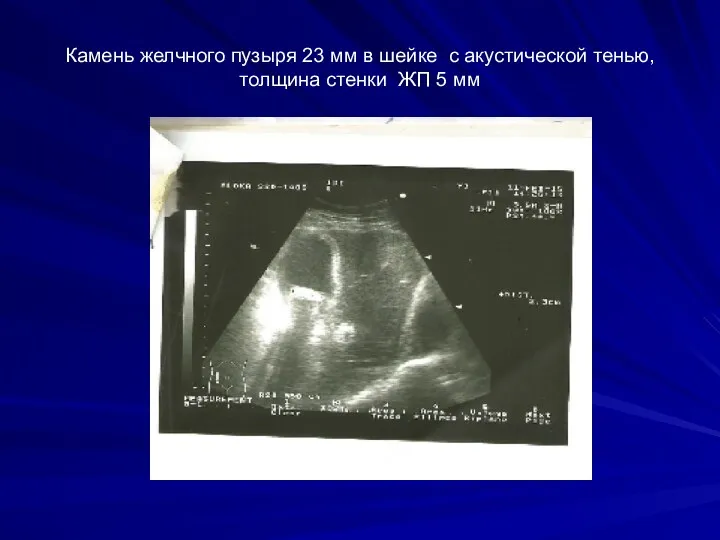 Камень желчного пузыря 23 мм в шейке с акустической тенью, толщина стенки ЖП 5 мм