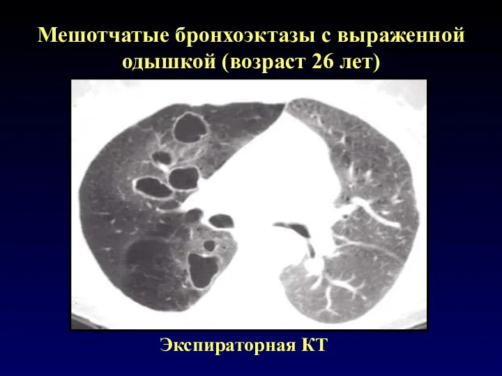 Мешотчатые бронхоэктазы с выраженной одышкой (возраст 26 лет) Экспираторная КТ