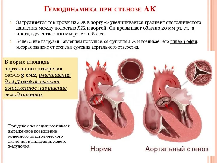 Гемодинамика при стенозе АК Затрудняется ток крови из ЛЖ в