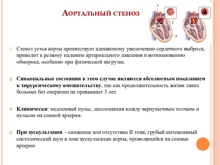 Аортальный стеноз Стеноз устья аорты препятствует адекватному увеличению сердечного выброса,