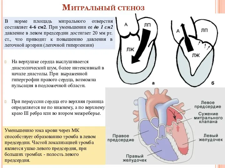 Митральный стеноз На верхушке сердца выслушивается диастолический шум, более интенсивный