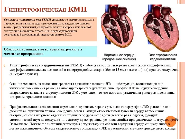 Гипертрофическая КМП Гипертрофическая кардиомиопатия (ГКМП) - заболевание с характерным комплексом