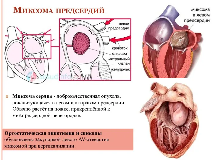 Миксома предсердий Миксома сердца - доброкачественная опухоль, локализующаяся в левом