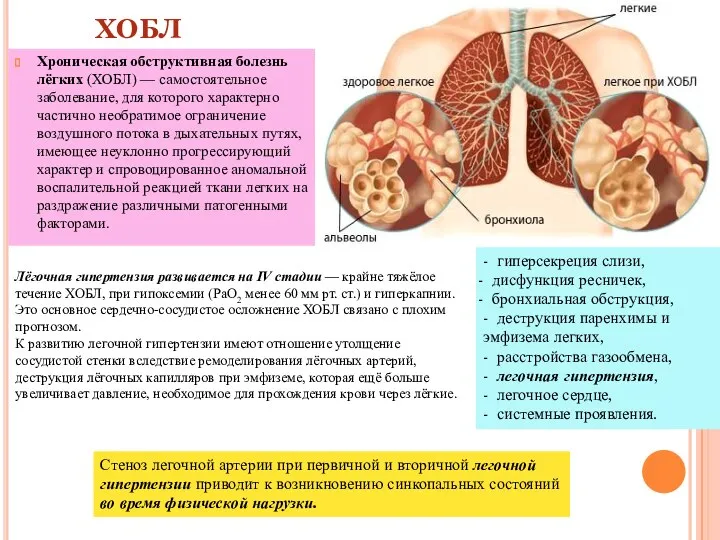 ХОБЛ Хроническая обструктивная болезнь лёгких (ХОБЛ) — самостоятельное заболевание, для