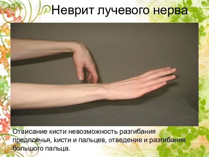 Неврит лучевого нерва Отвисание кисти невозможность разгибания предплечья, kисти и пальцев, oтведение и разгибания большого пальца.
