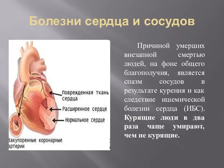 Болезни сердца и сосудов Причиной умерших внезапной смертью людей, на