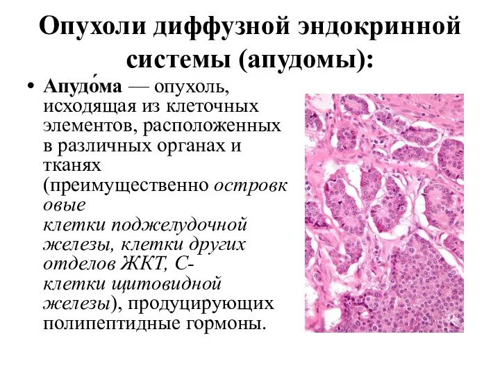 Опухоли диффузной эндокринной системы (апудомы): Апудо́ма — опухоль, исходящая из