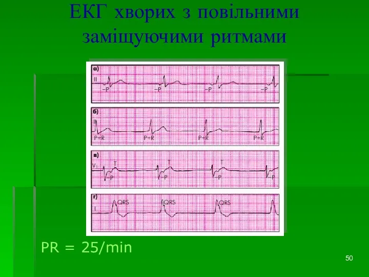 ЕКГ хворих з повільними заміщуючими ритмами PR = 25/min