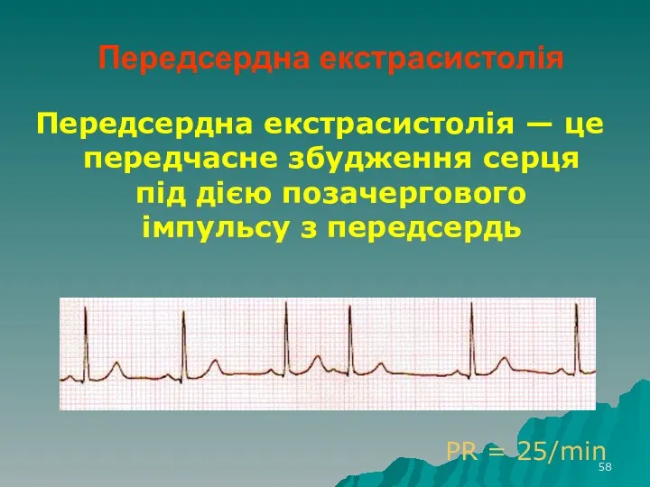 Передсердна екстрасистолія Передсердна екстрасистолія — це передчасне збудження серця під