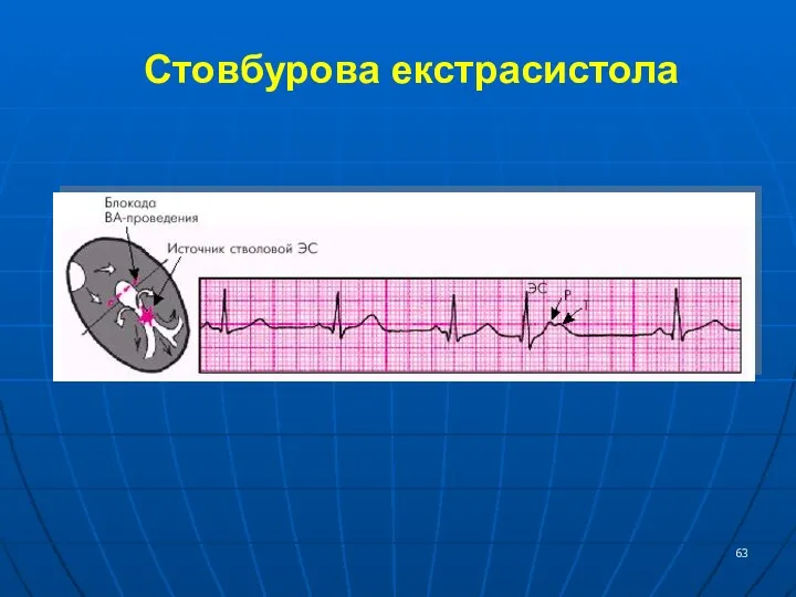 Стовбурова екстрасистола