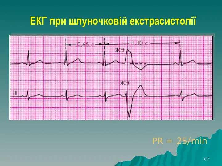 ЕКГ при шлуночковій екстрасистолії PR = 25/min