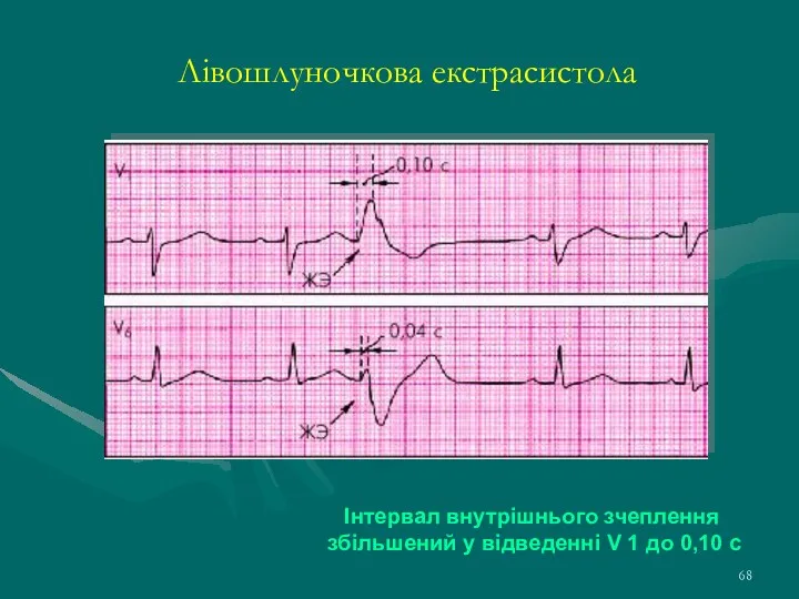 Лівошлуночкова екстрасистола Інтервал внутрішнього зчеплення збільшений у відведенні V 1 до 0,10 с