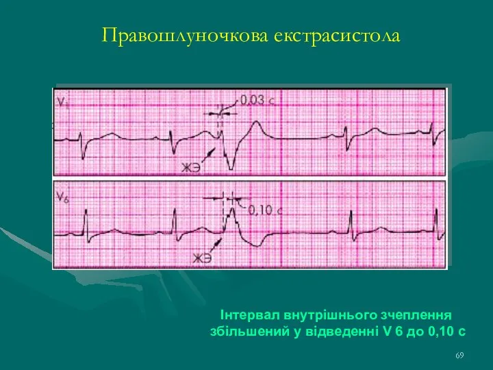 Правошлуночкова екстрасистола Інтервал внутрішнього зчеплення збільшений у відведенні V 6 до 0,10 с