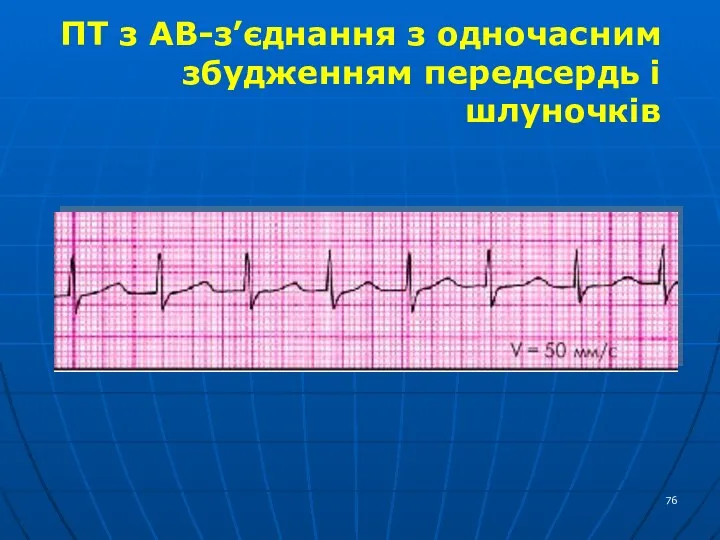 ПТ з АВ-з’єднання з одночасним збудженням передсердь і шлуночків