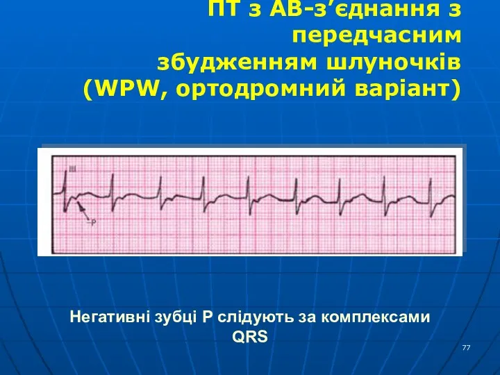 Негативні зубці Р слідують за комплексами QRS ПТ з АВ-з’єднання