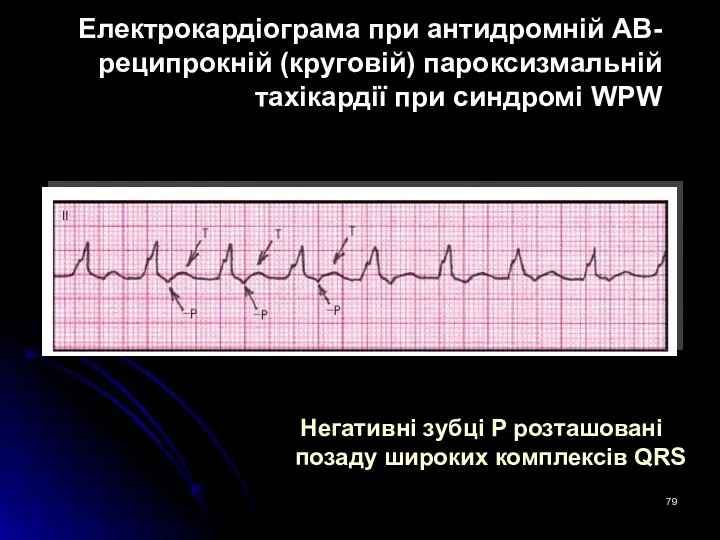 Електрокардіограма при антидромній АВ-реципрокній (круговій) пароксизмальній тахікардії при синдромі WPW