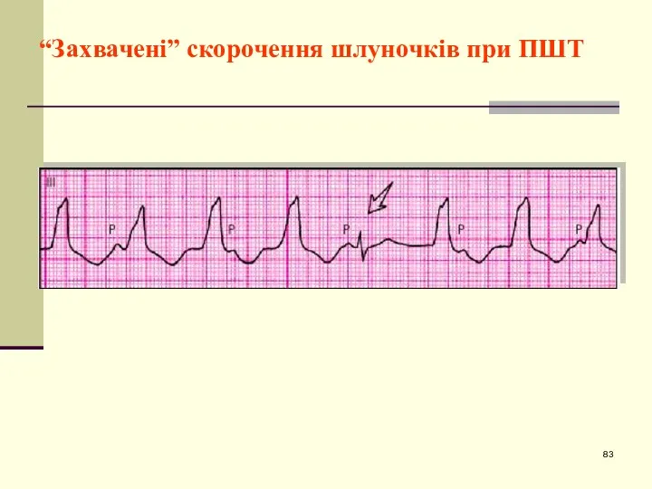 “Захвачені” скорочення шлуночків при ПШТ