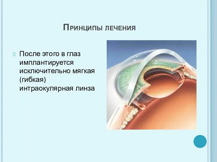 Принципы лечения После этого в глаз имплантируется исключительно мягкая (гибкая) интраокулярная линза