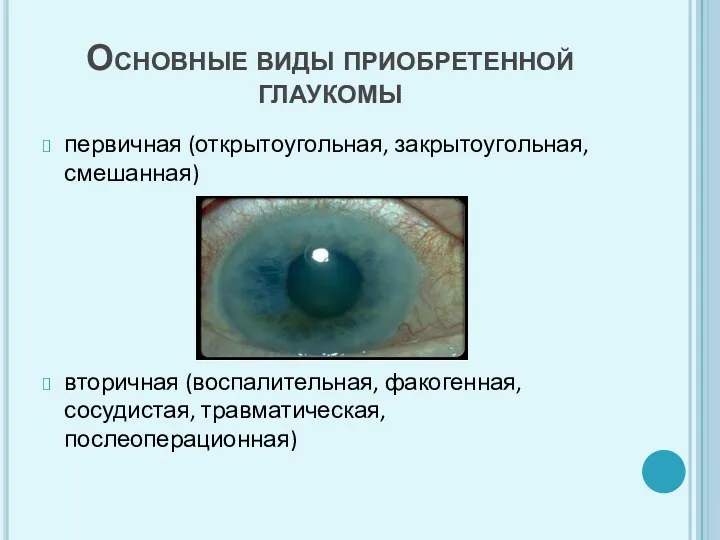Основные виды приобретенной глаукомы первичная (открытоугольная, закрытоугольная, смешанная) вторичная (воспалительная, факогенная, сосудистая, травматическая, послеоперационная)