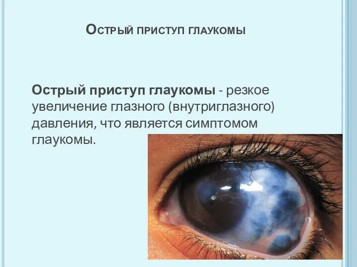 Острый приступ глаукомы Острый приступ глаукомы Острый приступ глаукомы -