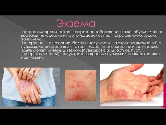 Экзема -острое или хроническое незаразное заболевание кожи, обусловленное воспалением дермы и проявляющееся сыпью,