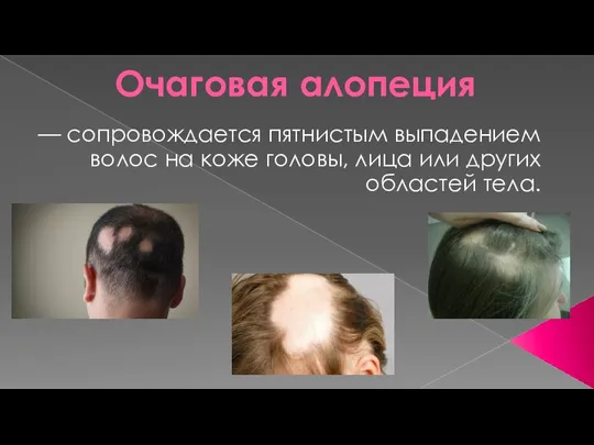Очаговая алопеция — сопровождается пятнистым выпадением волос на коже головы, лица или других областей тела.