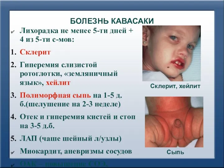 БОЛЕЗНЬ КАВАСАКИ Лихорадка не менее 5-ти дней + 4 из