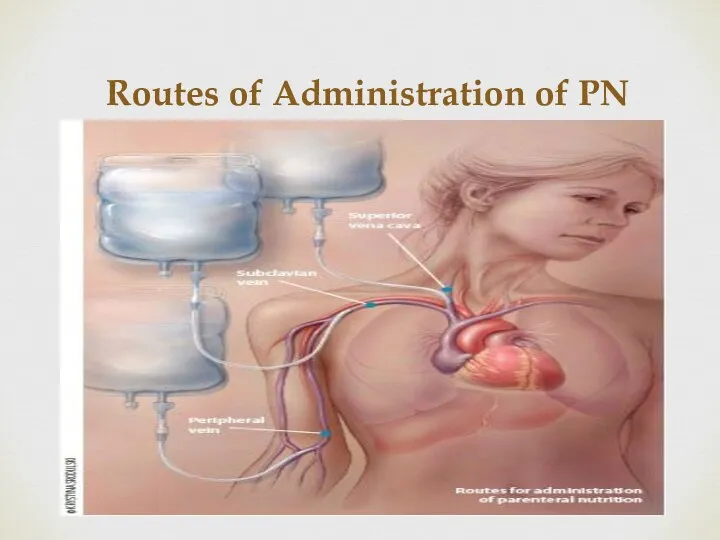 Routes of Administration of PN