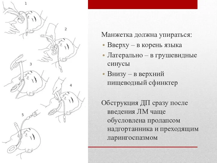 Манжетка должна упираться: Вверху – в корень языка Латерально –